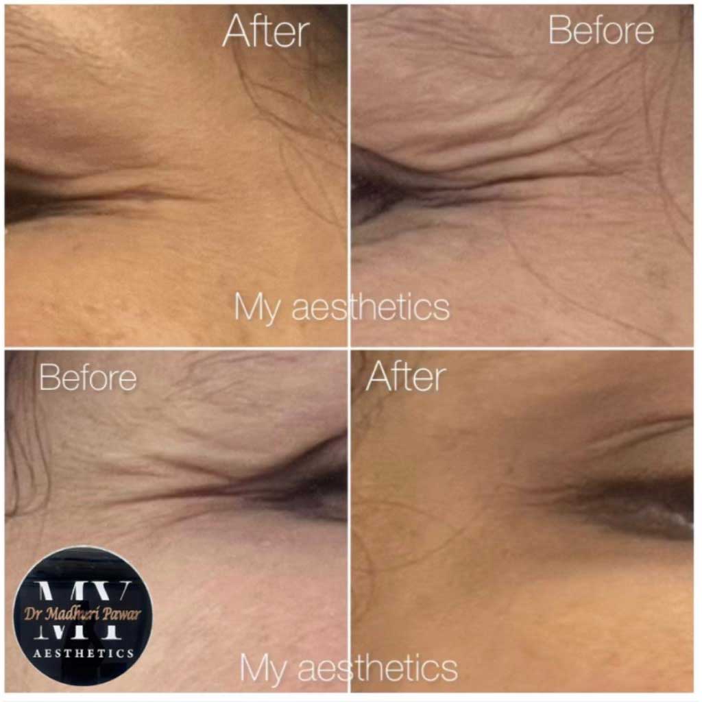 anti-aging