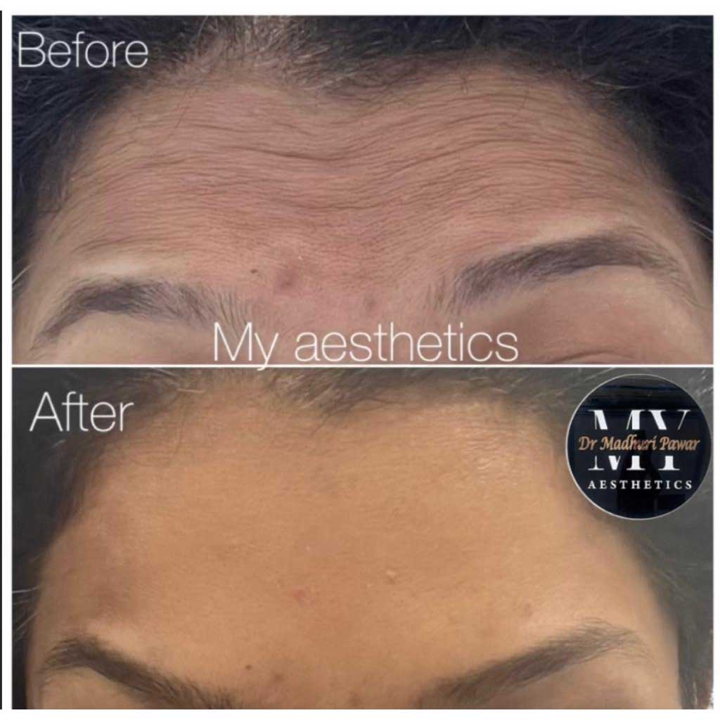 anti-aging