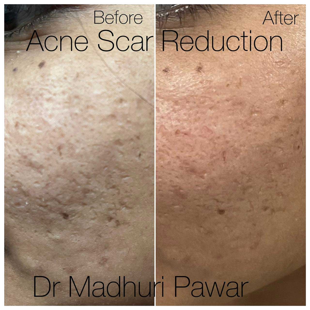 acne scar reduction