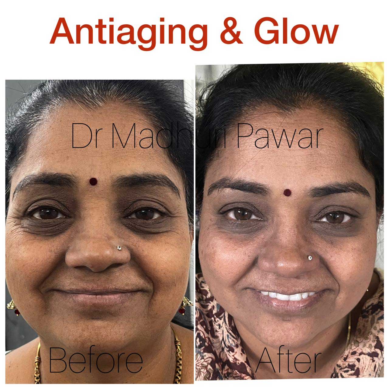 anti-aging