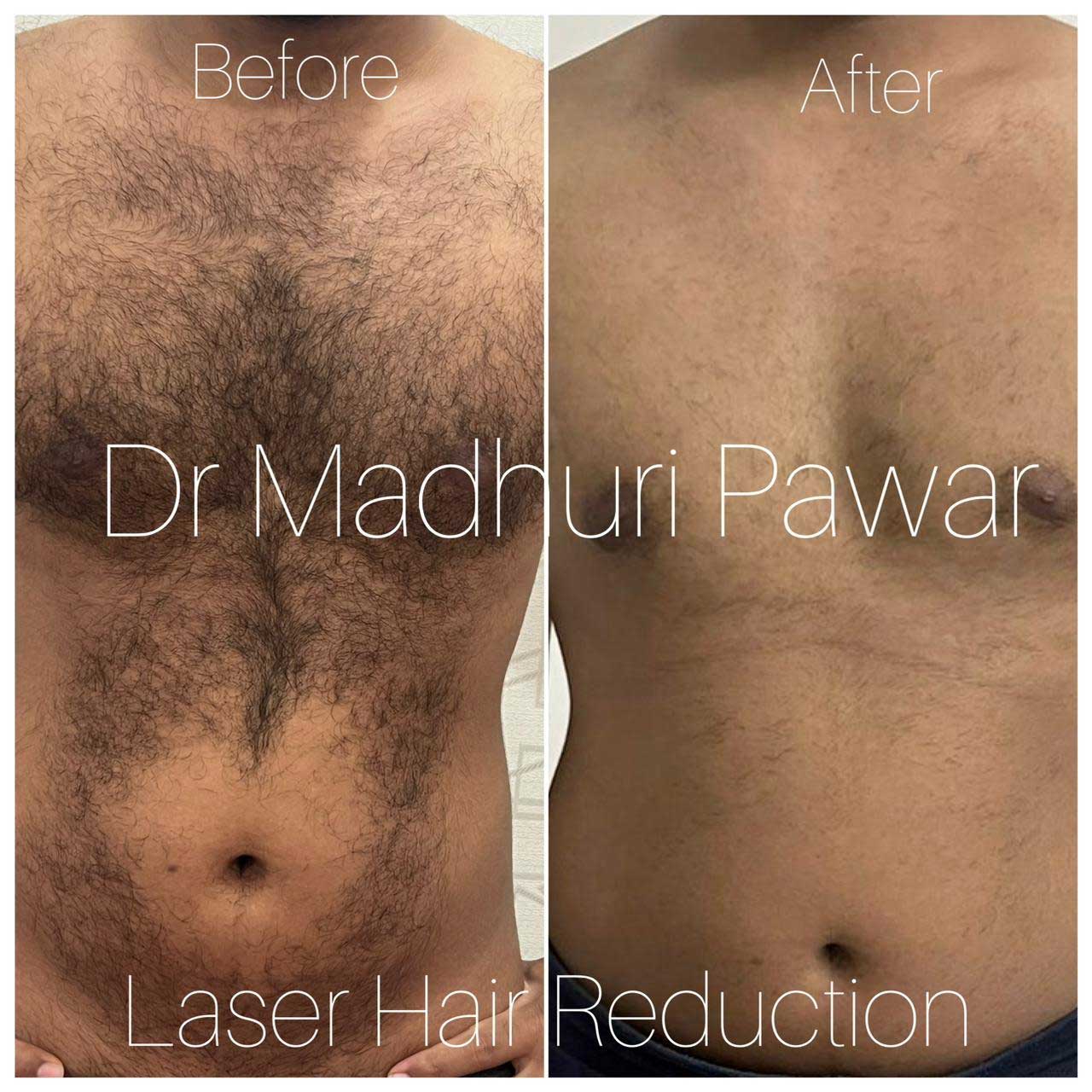 laser-hair-reduction