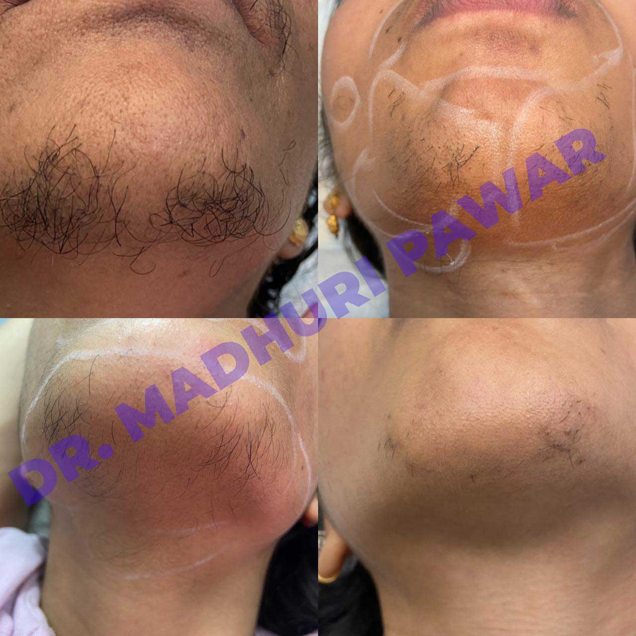 laser-hair-reduction