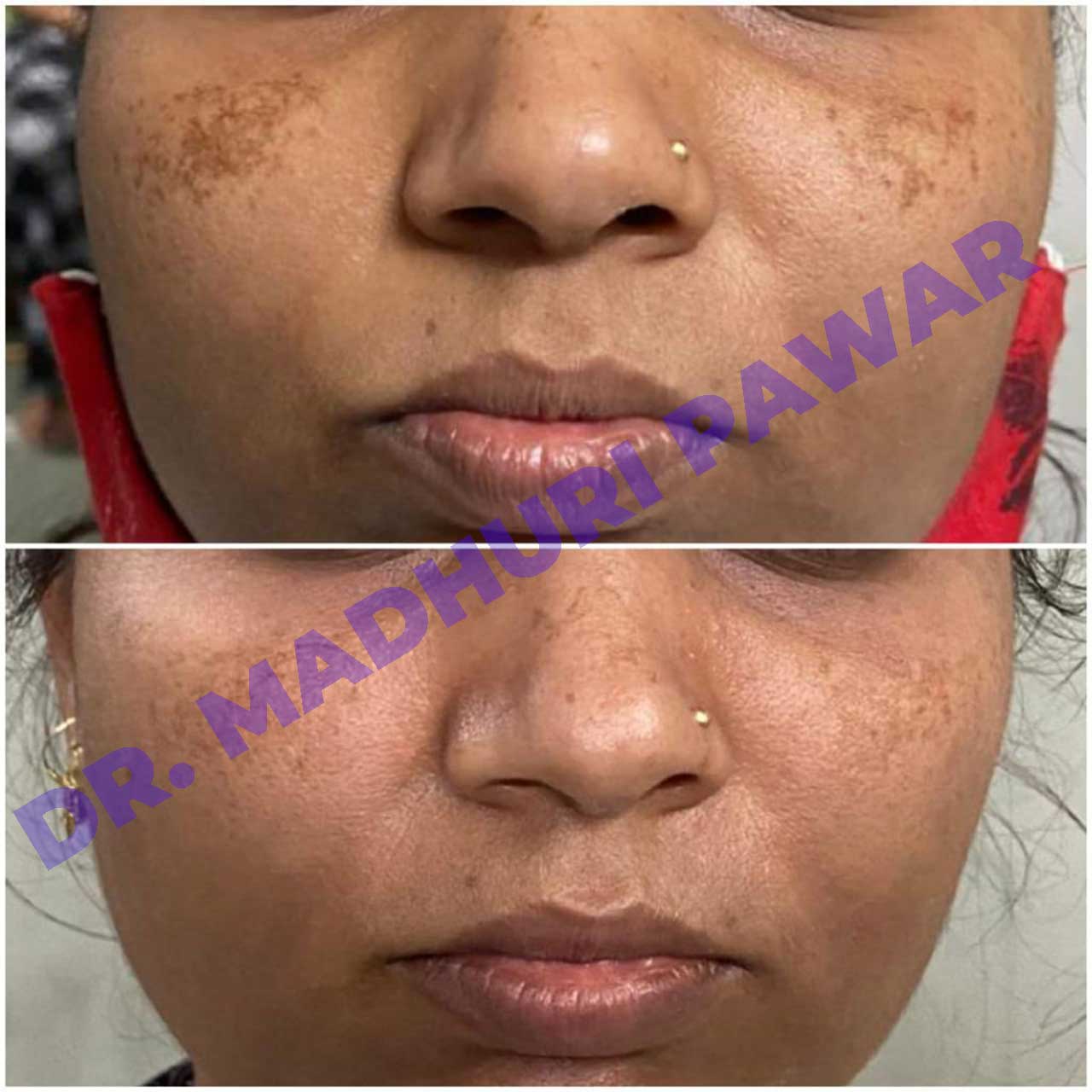 Pigmentation