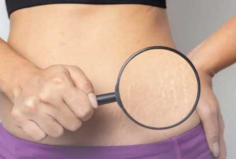 Stretch Marks
