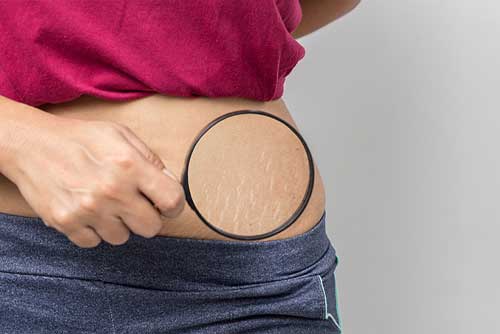 stretch-marks