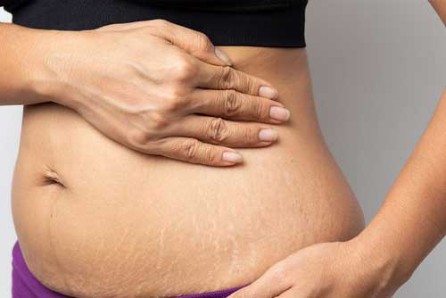 stretch-marks