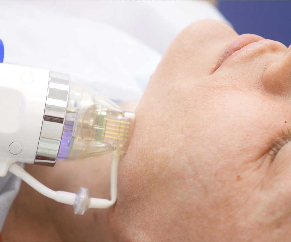 Microneedling RF