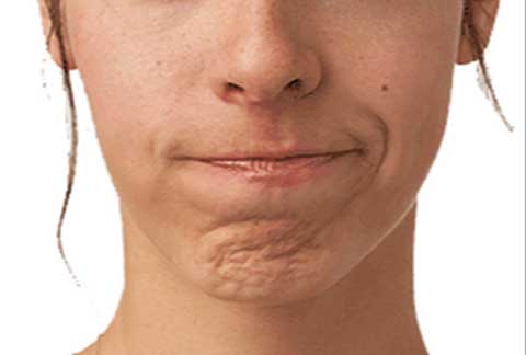 chin-crease