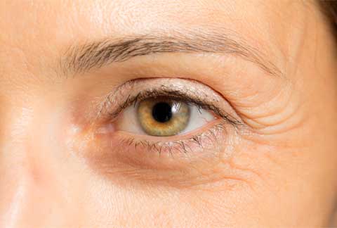 crows-feet-wrinkles