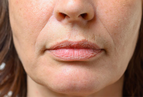 deep-nose-to-mouth-lines