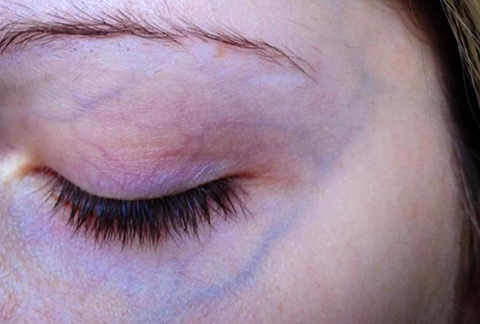 eye-veins
