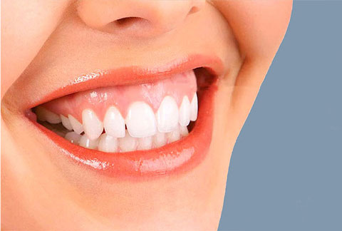 gummy-smile