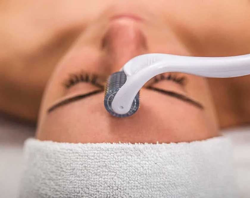 microneedling