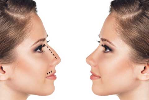 non-surgical-rhinoplasty