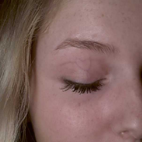eye-veins