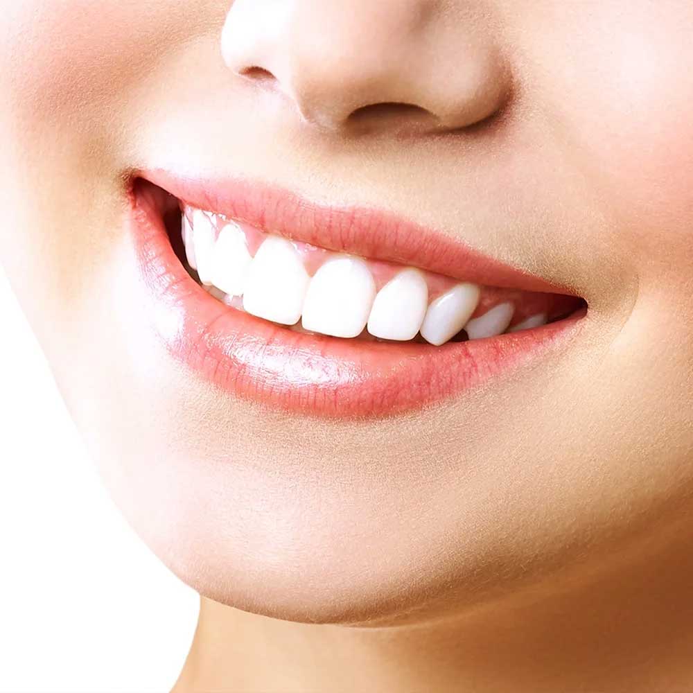 gummy-smile