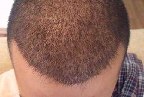 FUE Hair