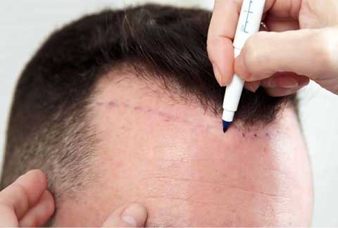 FUT Hair Transplants