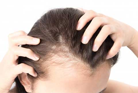 Hair Loss in Women
