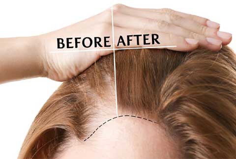 Hair Transplant for Women