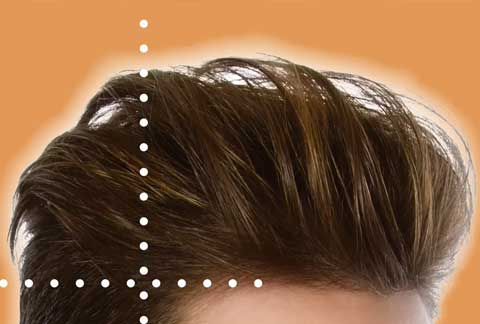 Hairline Hair Transplant