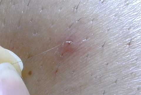 Ingrown Hairs