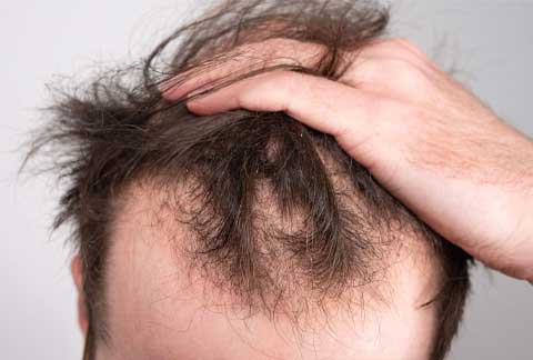 Male Hair Loss