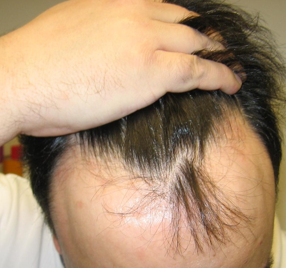 Hairline Hair Transplant