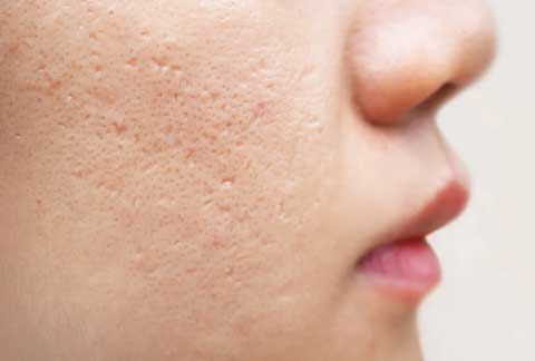 ACNE Scars