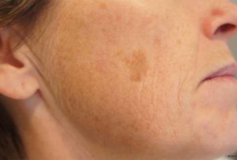 Age Spots