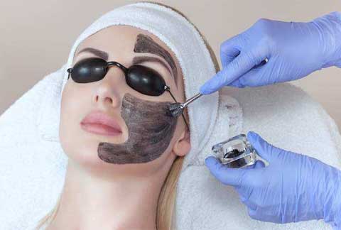 Carbon Peel