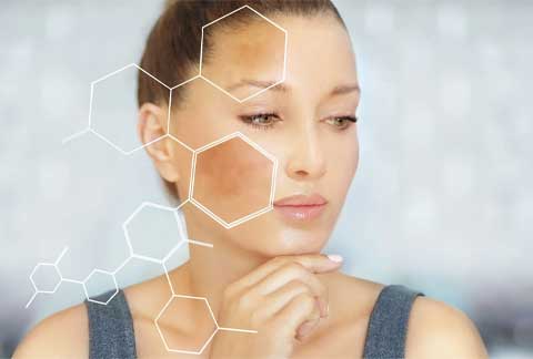 Melasma