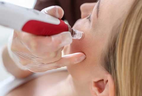 Micro Needling