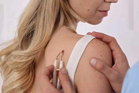Skin Tags